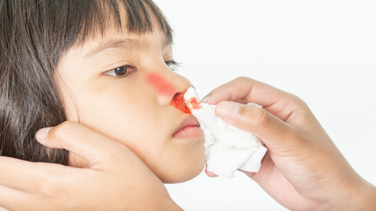 Epistaxis: Understanding and Managing Nosebleeds